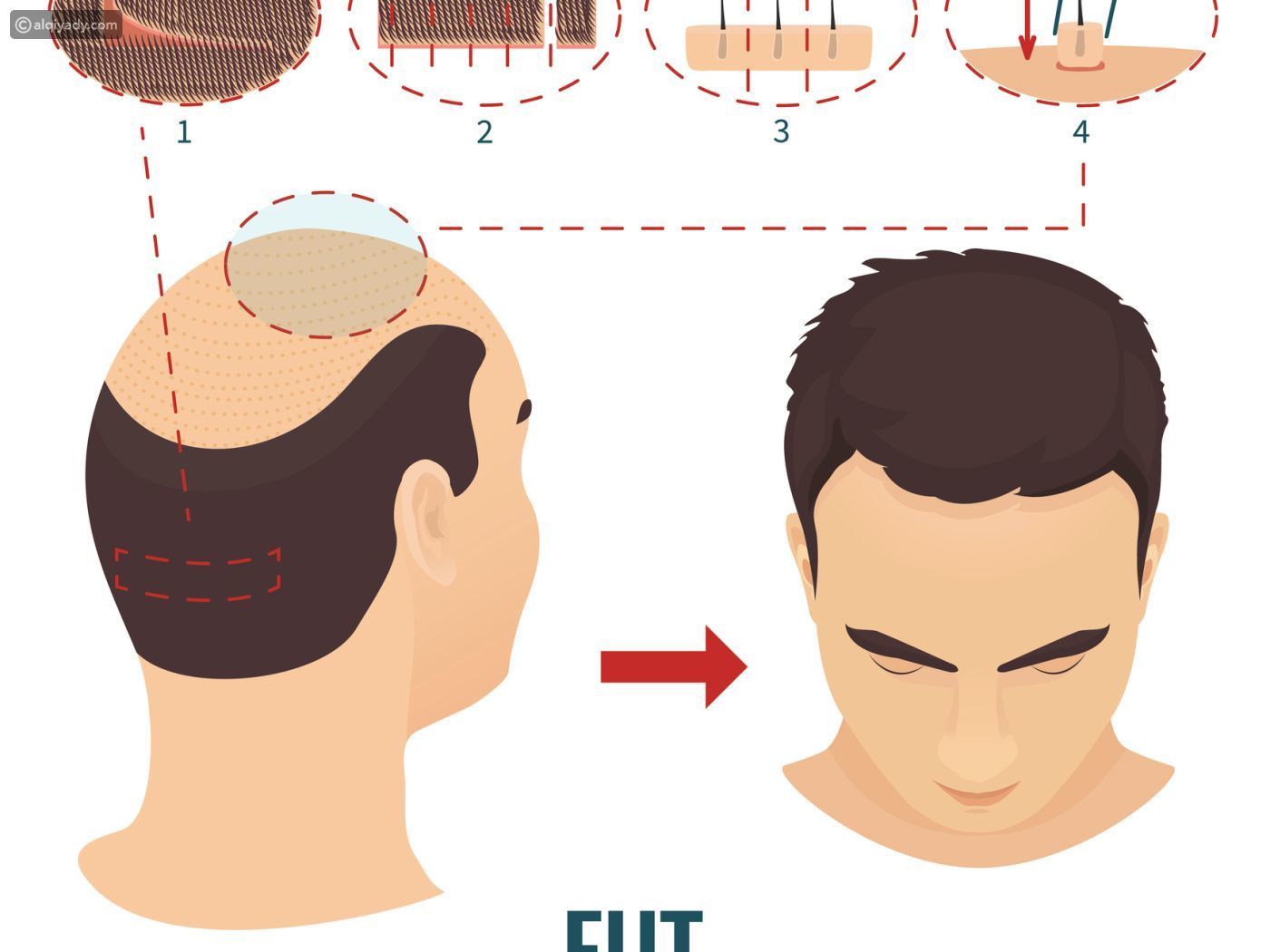 تقنية الششريحة لزراعة الشعر
