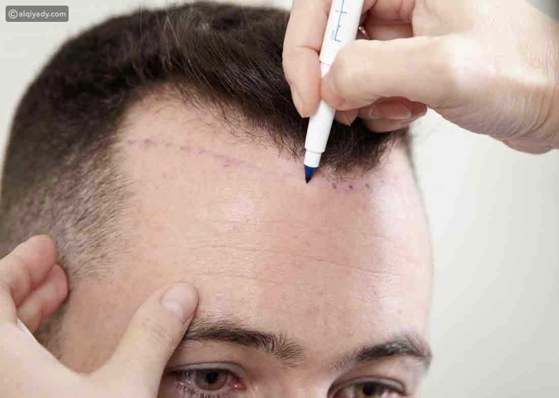تقنية (DHI - Direct Hair Implantation) لزراعة الشعر